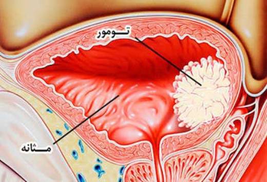 سرطان مثانه طی سالهای اخیر شیوع بالایی داشته است