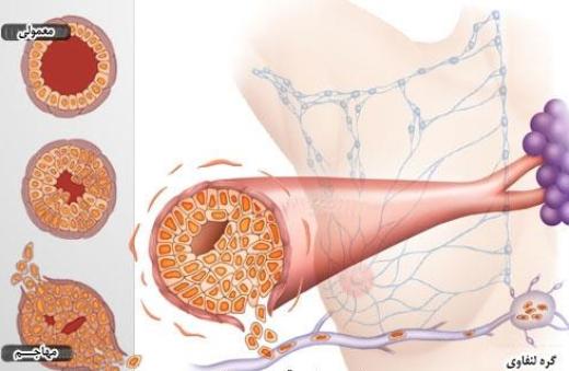 غربالگری موجب تشخیص زودهنگام سرطان پستان می‌شود