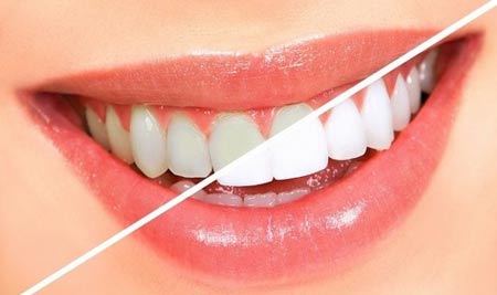 هر آنچه در مورد سفید کردن دندان باید بدانید