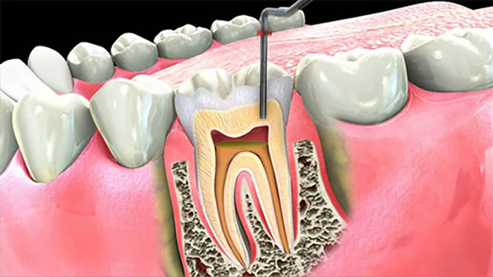هر آنچه باید در مورد درمان ریشه دندان بدانيد