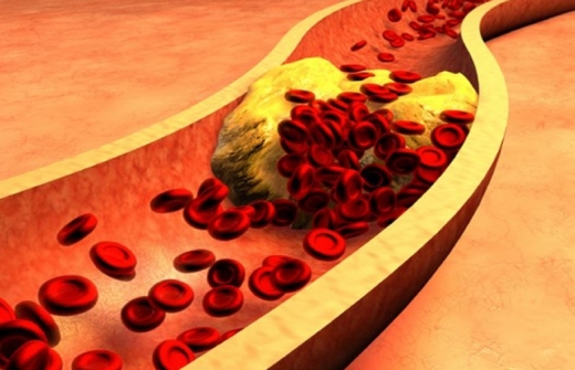 عوامل خطر چربی خون کدامند؟