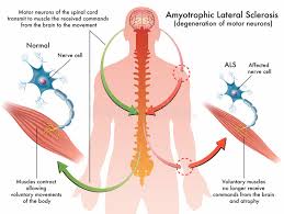 Als غم انگیزترین بیماری عصبی عضلانی