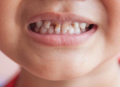 حدود۹۰درصد کودکان ۶ساله دچار پوسیدگی دندان هستند
