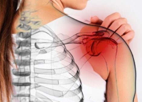 آنچه باید در مورد علائم و درمان شانه یخ‌زده بدانید